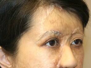 eyebrow transplant - patient 21 - before 3