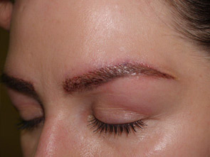 eyebrow and eyelashes - patient 115 - after immediately 2