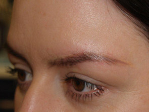 eyebrow and eyelashes - patient 115 - before 2