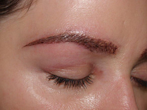 eyebrow and eyelashes - patient 115 - after immediately 1