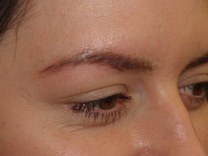 eyebrow and eyelashes - patient 115 - before 1