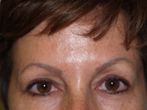eyebrow and eyelashes - patient 116 - before 1