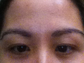 eyebrow transplant - patient 20 - after 1