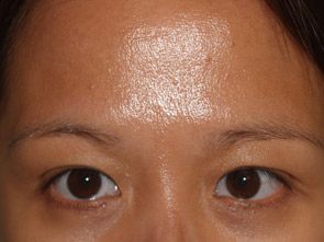 eyebrow transplant - patient 20 - before 1