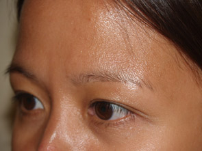 eyebrow transplant - patient 20 - before 2