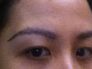 eyebrow transplant - patient 20 - after 3