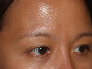 eyebrow transplant - patient 20 - before 3