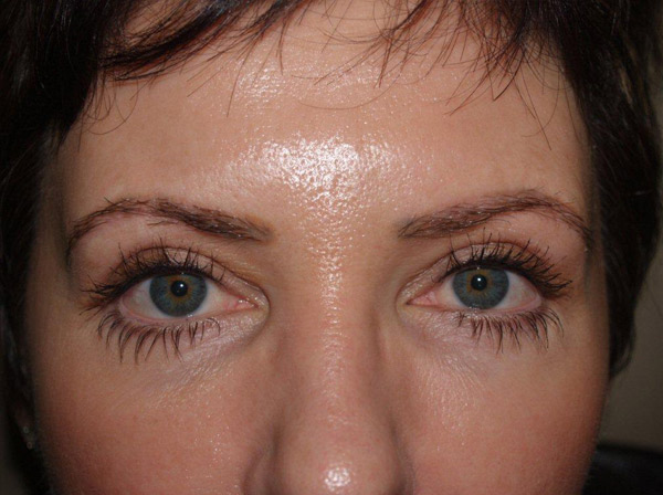 eyebrow transplant - patient 14 - after immediately 4