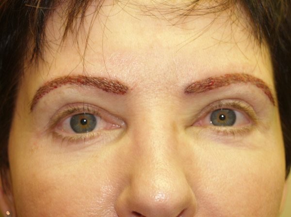eyebrow transplant - patient 14 - after immediately 1