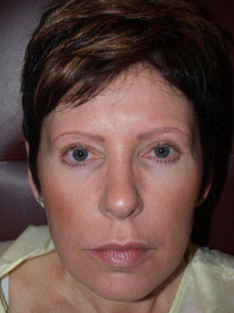 eyebrow transplant - patient 14 - before 1