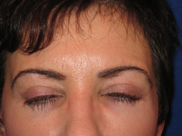 eyebrow transplant - patient 14 - after 2