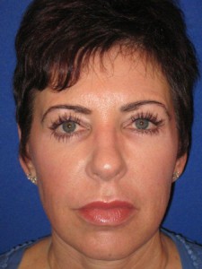 Miami, Fl. Eyebrow transplant Photo - Patient 1 - After 1