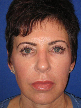 eyebrow transplant - patient 14 - after 1
