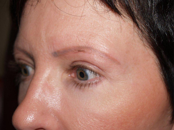 eyebrow transplant - patient 14 - before 4