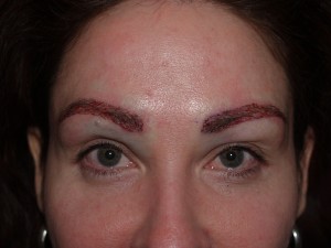 Miami, Fl. Eyebrow and Eyelashes Photo - Patient 1 - After 1