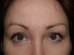 Miami, Fl. Eyebrow and Eyelashes Photo - Patient 1 - Before 1