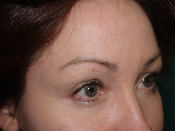 eyebrow and eyelashes - patient 81 - before 2
