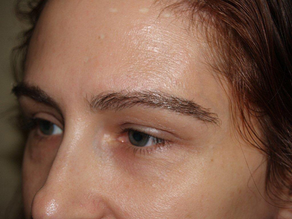 eyebrow transplant - patient 5 - after 2