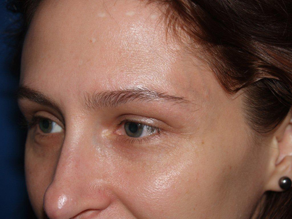 eyebrow transplant - patient 5 - before 2