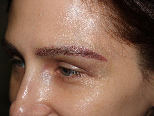 eyebrow transplant - patient 5 - after immediately 2