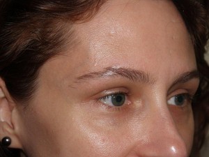 Miami, Fl. Eyebrow transplant Photo - Patient 1 - Before 1