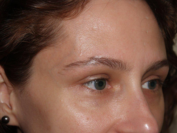 eyebrow transplant - patient 5 - before 1