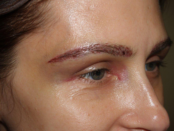 eyebrow transplant - patient 5 - after immediately 1