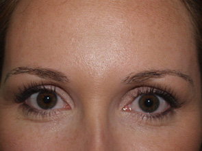 eyebrow and eyelashes - patient 111 - after 1