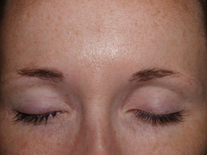 eyebrow and eyelashes - patient 111 - before 1