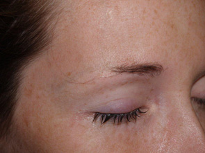 eyebrow and eyelashes - patient 111 - before 2
