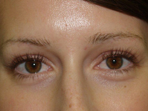 eyebrow and eyelashes - patient 112 - before 1