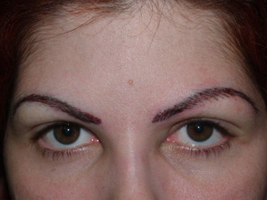 eyebrow transplant - patient 10 - after immediately 1