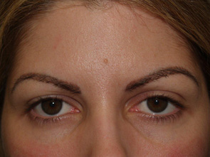 eyebrow transplant - patient 10 - after 1