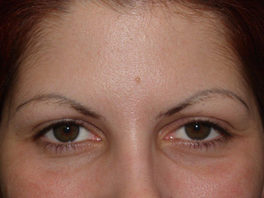 eyebrow transplant - patient 10 - before 1