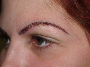 eyebrow transplant - patient 10 - after immediately 2