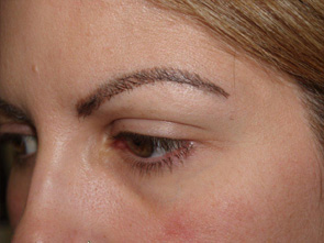 eyebrow transplant - patient 10 - after 2