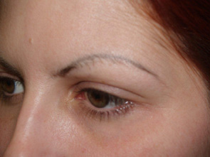eyebrow transplant - patient 10 - before 2
