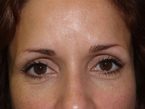 eyebrow transplant - patient 53 - before 1