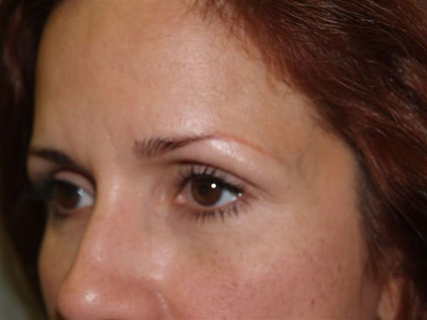 eyebrow transplant - patient 53 - before 2