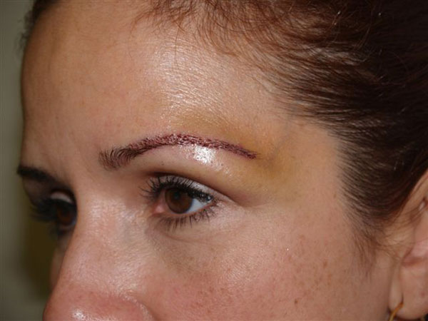 eyebrow transplant - patient 53 - after 3