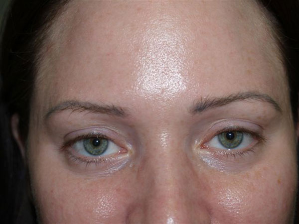 eyebrow transplant - patient 32 - before 1