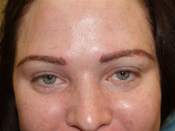 eyebrow transplant - patient 32 - after 1