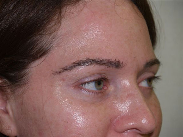 eyebrow transplant - patient 32 - after immediately 2