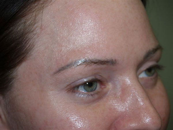 eyebrow transplant - patient 32 - before 2
