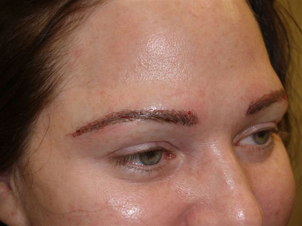 eyebrow transplant - patient 32 - after 2