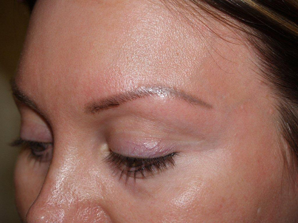 eyebrow transplant - patient 13 - before 2