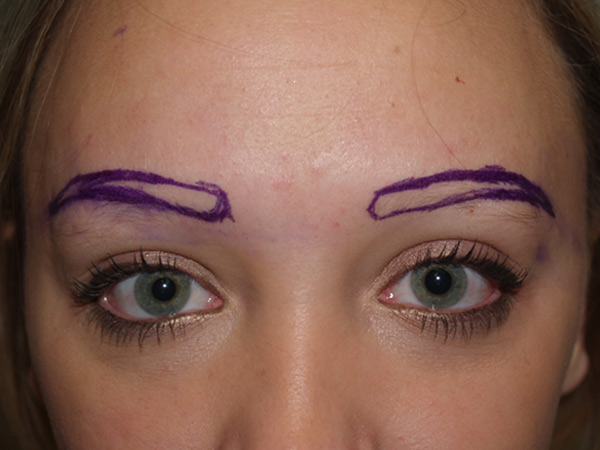 eyebrow and eyelashes - patient 100 - before marked 1