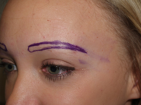 eyebrow and eyelashes - patient 100 - before marked 2