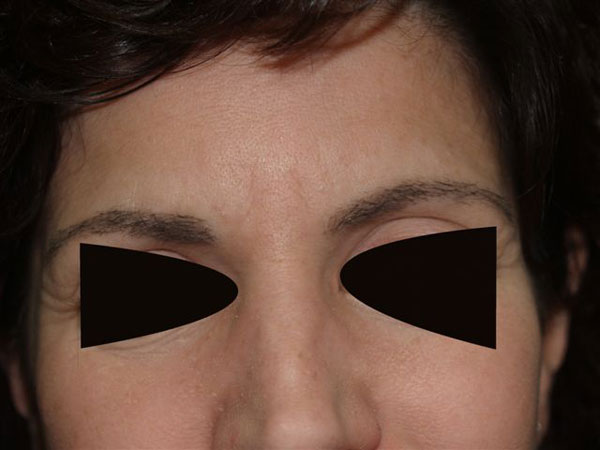 eyebrow transplant - patient 47 - after 1