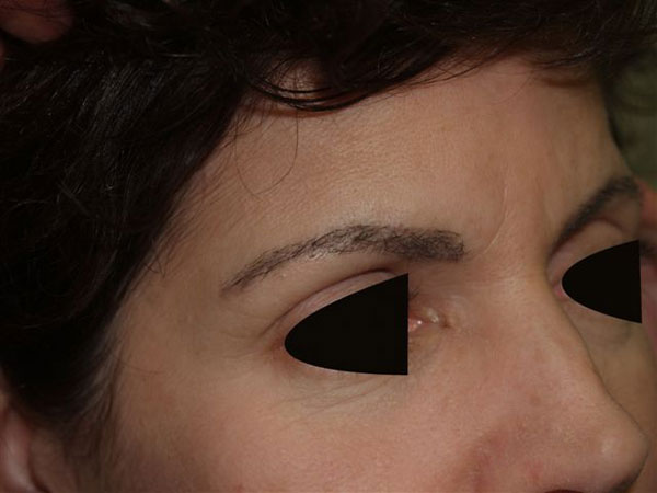 eyebrow transplant - patient 47 - after 2